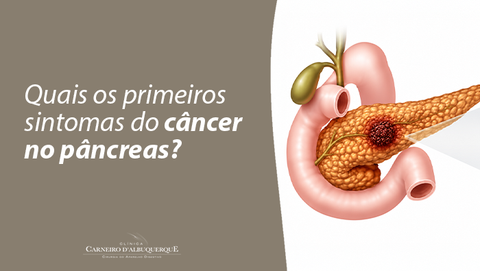 Arte sobre primeiros sintomas do câncer no pâncreas