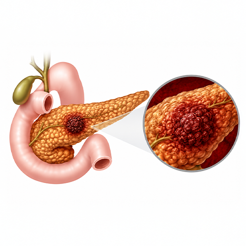 Ilustração médica do pâncreas com tumor