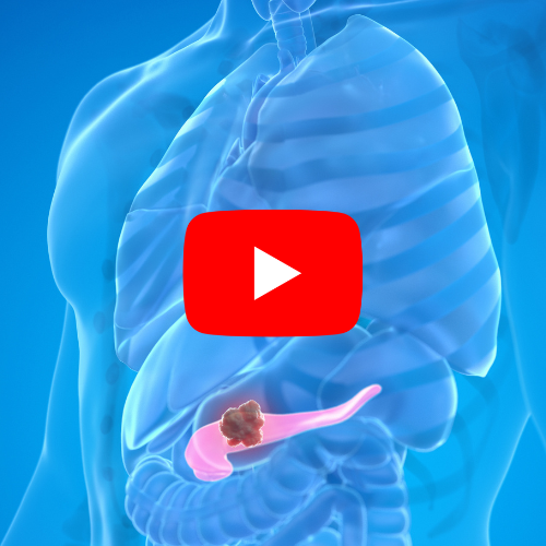 Ilustração médica do sistema digestivo com tumor em destaque